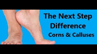 The Next Step Difference:  Corns \u0026 Calluses