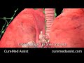 Types And Staging Of Lung Cancer – CureMed Assist – Medical Tourism Company