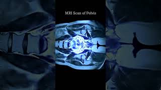 MRI scan of Pelvis #shorts