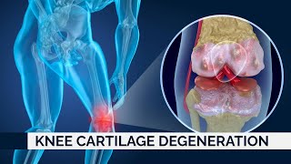 Knee Cartilage Degeneration | Prof. Dr. Yakup YILDIRIM