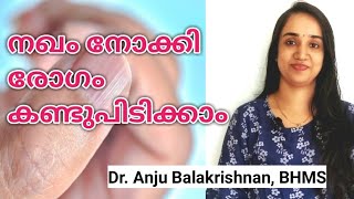 Finger nails can tell your health | Nail discoloration clues disease | Nail colour change & diseases