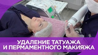 Удаление ТАТУАЖА и ПЕРМАНЕНТНОГО МАКИЯЖА ЛАЗЕРОМ и РЕМУВЕРОМ. Обучающее видео от Татуэль