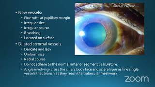 Neovascular Glaucoma NVG Dr Sourabh Patwardhan Nandadeep Eye Hospital's Personal Meeting Room