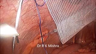 Laparoscopic Repair of Incisional Hernia by Dr. R.K. Mishra