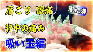 【恵比寿吸い玉】肩こり腰痛背中の痛みを何とかして欲しい！カッピング【渋谷区恵比寿・鍼灸院・整体】コスモ治療院（リメイク）