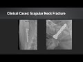 OrthoLine™ Fracture Management System: Clinical Case Series