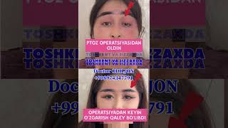 Ptoz korreksiyasi | қовоқ олиш | blefaroplastika Doctor ODILJON +998974347791 TOSHKENT VA JIZZAXDA