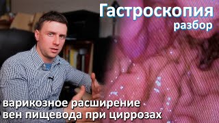 Варикозное расширение вен пищевода и желудка при циррозах печени. Разбор гастроскопии