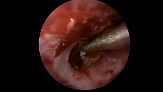 Ear drum repair (tympanoplasty) with lateral graft