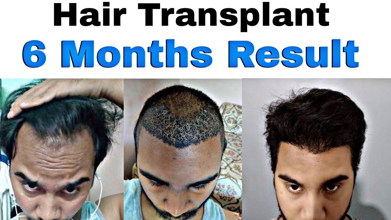 My 6 Months Hair Transplant Result Timeline || Hair Transplant Before ...