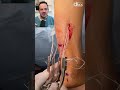 DOCTOR REACTS: AMAZING WAY OF REPAIRING A TENDON RUPTURE!😱#shorts