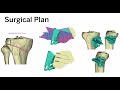 Patient Specific High Tibial Osteotomy: Osteochondral Allograft