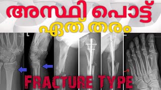 എല്ല് /അസ്ഥി പൊട്ട് ഏതു തരം | Type of fracture