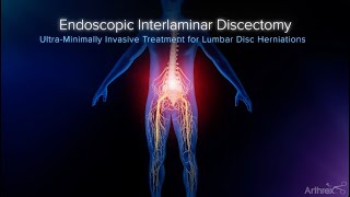 Interlaminar Approach to Disc Herniation Treatment