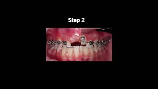 How do braces work?