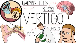 Vertigo Made Easy - Causes, Symptoms and Treatment