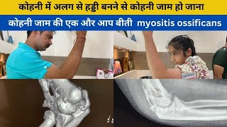 कोहनी की ऐसी समस्या जो कोहनी को कर देती हैं पूर्ण रूप से जाम क्या हैं कारण | myositis ossificans