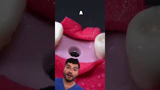 Dental Implant Explained !?