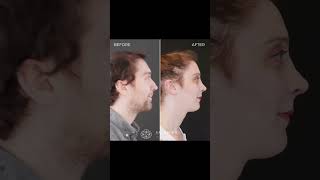 Facial Feminization (FFS) Before and After