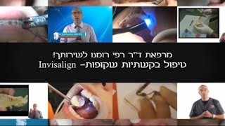 קשתיות שקופות ליישור שיניים - ד\