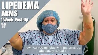 Lipedema Reduction Surgery: Arms | One-Week Post-Op | Liposuction \u0026 Manual Lipedema Extraction