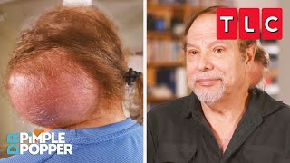 This Man Has a Softball-Sized Bump on His Neck! | Dr. Pimple Popper | TLC