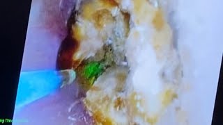 Dr Gary Bellman demonstrates the use of the new thulium laser to treat a large kidney stone