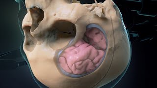 Microsurgical Clipping of a Basilar Bifurcation Aneurysm