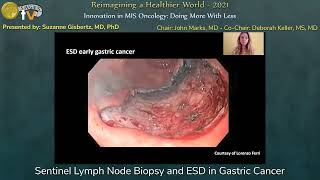 Sentinel Lymph Node Biopsy and ESD in Gastric Cancer