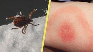 What bit me? Spot the difference between a spider, tick or mosquito bite - Health and Weather
