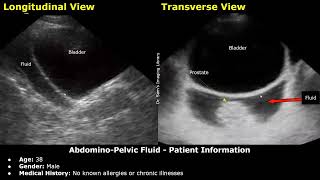 FAST Ultrasound Scan Reporting | Pericardial Effusion, Abdomino-Pelvic Fluid Case Reports Trauma USG