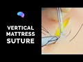 Vertical Mattress Suture - OSCE Guide | UKMLA | CPSA | PLAB 2