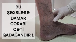 varikoz damar corabi kimlere olmaz qadagandi fleboloq damar cerrahi ismayil esgerov mualice elastik