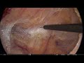 Laparoscopic low anterior resection