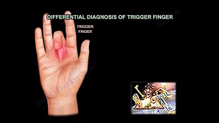 Differential Diagnosis of Trigger Finger - Everything You Need To Know - Dr. Nabil Ebraheim