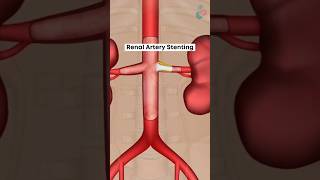 एक प्रक्रिया जो आपकी गुर्दे की धमनियों में रुकावटों को खोलती है  3D Medical Animation #RenalArteries