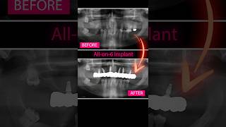 Discover the Perfect Transformation with All-on-6 Implants Supported by Monolithic Zirconia Crowns!