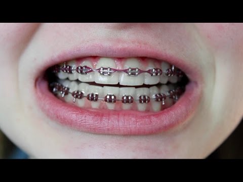 BRACES Q&A (Rubber bands, Pain, Tips) BRACES Q&A (Rubber bands, Pain, Tips)