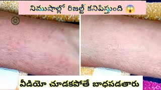 రిజల్ట్ చూసి ఆశ్చర్యపోతారు 😱|ఒంట్లో వేడినీ చమట కాయల్ని నిమిషాలలో తగ్గించే చిట్కా |summer skin care