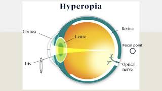 Corneal laser surgery