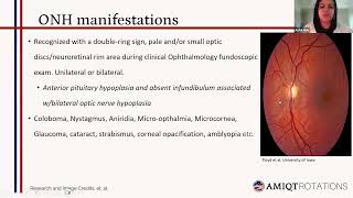 Septal Optic Dysplasia presented by Anfal Helu