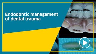 Endodontic management of dental trauma