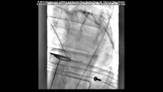 Case report: PCI during cardiac arrest - Supplementary video 1 [57953]