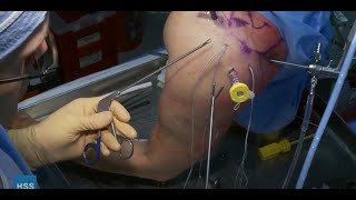 For Surgical First Assist: Arthroscopic Rotator Cuff Repair (Cadaveric)