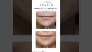 How the Botox Lip Lift Works #smile