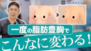 脂肪豊胸 どれくらい大きくなるか？/北條誠至 医師｜Mods Clinic（モッズクリニック）