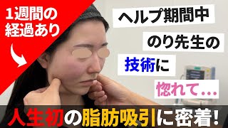 【20代女性脂肪吸引】ヘルプに来た時のり先生の実力に惚れて…😊 そんな他院スタッフの脂肪吸引に密着！