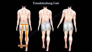 Trendelenburg Gait: Causes, Symptoms, and Role of the Gluteus Medius