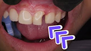 Tambal Gigi Patah | Dentist | Dokter Gigi Tri Putra