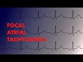 Focal Atrial Tachycardia - EKG Interpretation - MEDZCOOL